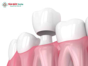 Bọc răng sứ bị cộm: nguyên nhân, dấu hiệu và cách xử lý