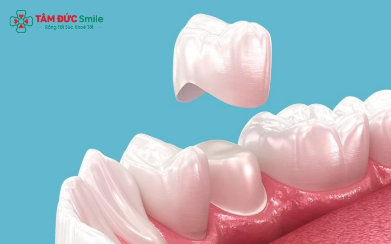 Răng sứ chế tác sai kích thước hoặc lắp không sát khít là nguyên nhân chính dẫn đến cảm giác cộm cấn, khó chịu khi ăn nhai.