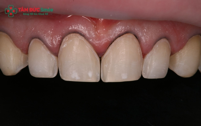 Việc mài răng quá đà hoặc lấy dấu hàm không chính xác dẫn đến răng sứ không sát khít, gây tích tụ vi khuẩn