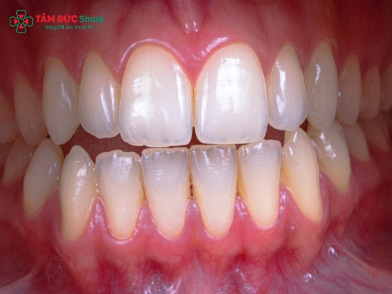 Cách trị tụt nướu răng tại nhà giảm ê buốt, hở chân răng