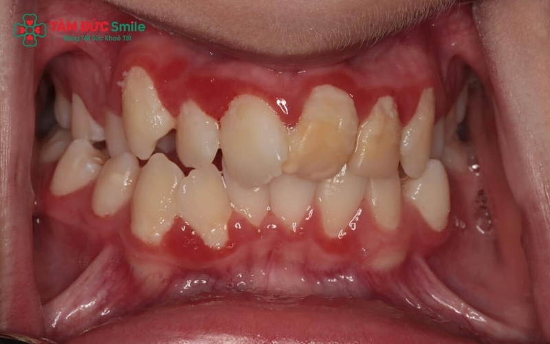 Cần cảnh giác nếu chảy máu chân răng đi kèm với các vết loét không lành sau 2 tuần hoặc xuất hiện các mảng màu trắng, đỏ bất thường trên nướu