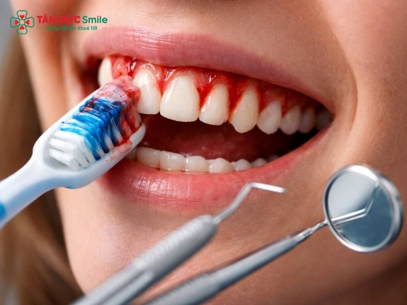 Chảy máu chân răng ung thư? Dấu hiệu, nguyên nhân, cách điều trị
