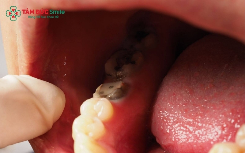 Chữa sâu răng bằng lá lốt là mẹo dân gian truyền miệng, nhưng thực tế nó chỉ có tác dụng giảm đau tạm thời chứ không thể tiêu diệt triệt để ổ sâu