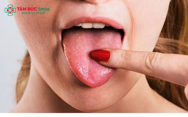 Lớp rêu lưỡi dày, trắng hoặc vàng là dấu hiệu cho thấy vi khuẩn đang phát triển mạnh, gây ra mùi hôi và vị đắng trong khoang miệng