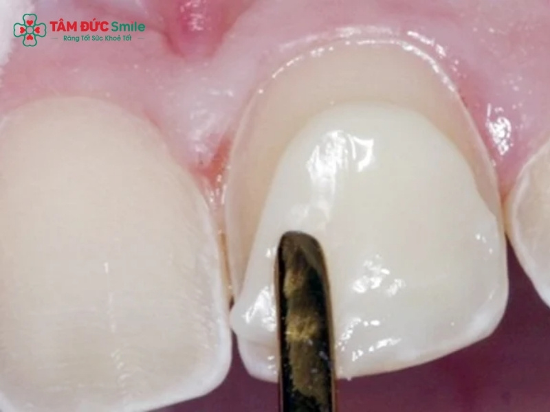 Làm răng khểnh thẩm mỹ đẹp tự nhiên, an toàn tại Tâm Đức Smile