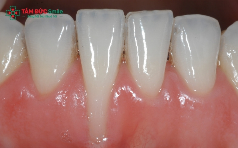 Mô nướu đã bị mất đi không thể tự mọc lại như ban đầu; việc điều trị cần sự can thiệp của các kỹ thuật nha khoa chuyên sâu để ngăn chặn tình trạng nặng hơn.