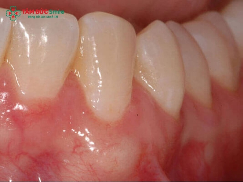 Lợi mỏng lộ chân răng: Nguyên nhân, điều trị tụt lợi hiệu quả