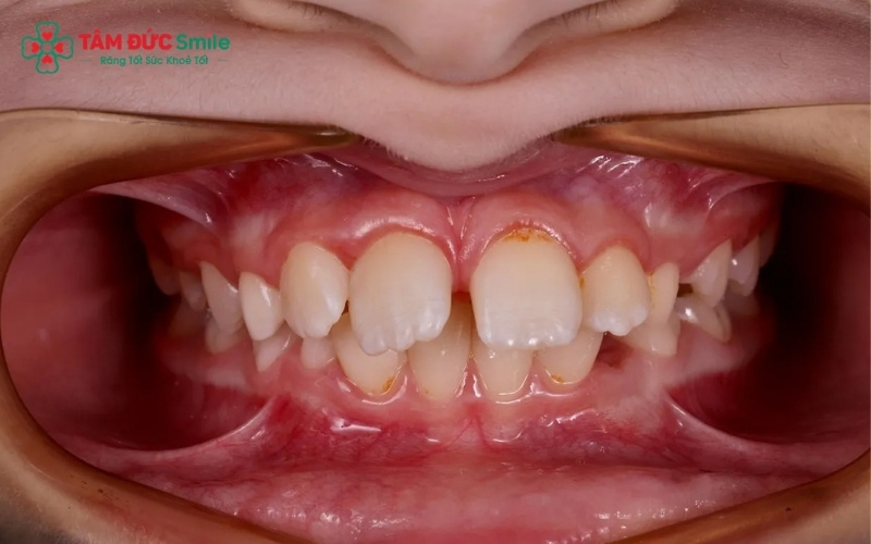 Thói quen nghiến răng hoặc áp lực ăn nhai quá mức là những yếu tố kích thích xương hàm phát triển các khối lồi để tăng khả năng chịu lực.