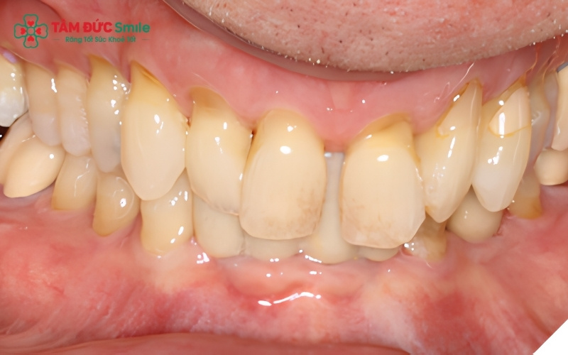 Lồi xương chân răng thường là những khối cứng, không di động, có màu sắc tương đồng với mô nướu xung quanh và phát triển chậm theo thời gian