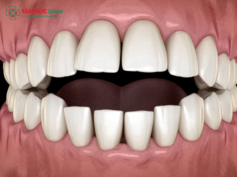 Lồi xương chân răng: Dấu hiệu, nguyên nhân và cách điều trị