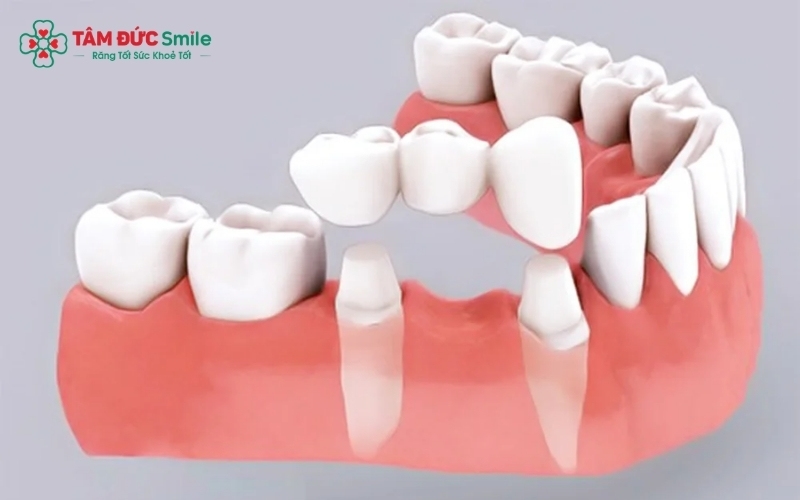 Ba phương pháp phục hình răng số 6 phổ biến hiện nay: Hàm giả tháo lắp, Cầu răng sứ và Trồng răng Implant.