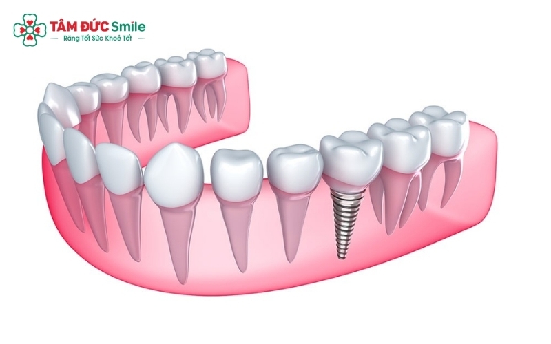 Trồng răng Implant ưu việt hơn nhờ khả năng ăn nhai như răng thật và ngăn chặn triệt để tình trạng tiêu xương hàm, hóp má.