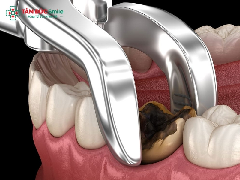 Nhổ răng hàm bị sâu an toàn, ít đau, chi phí rõ tại Tâm Đức Smile