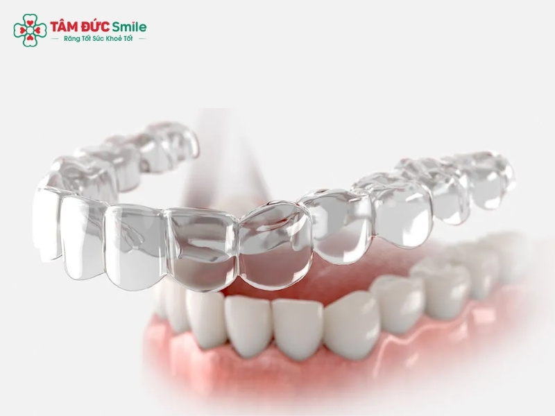 Niềng răng trong suốt tại nhà: Khay Invisalign an toàn, thẩm mỹ