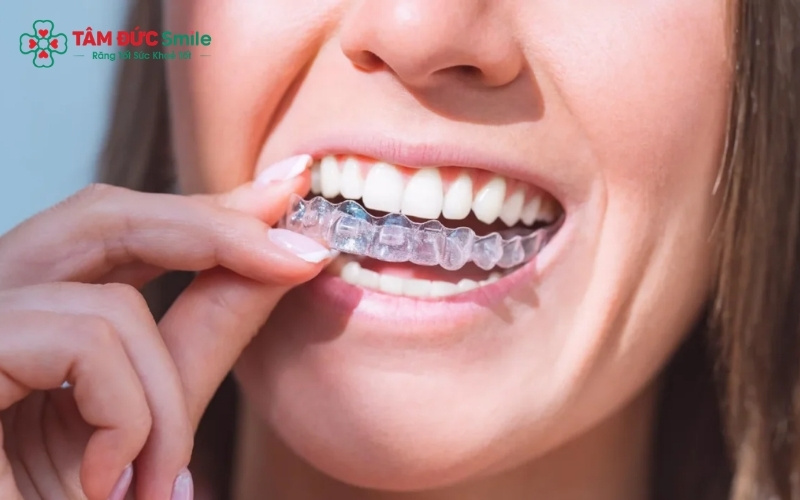 Sự đồng hành và giám sát chuyên môn của bác sĩ là yếu tố quyết định tính an toàn và hiệu quả của ca niềng.