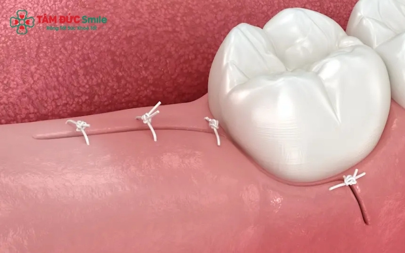 Quá trình lành thương diễn ra theo từng giai đoạn, nướu thường sẽ đóng kín hoàn toàn sau khoảng 2 tuần và xương hàm cần vài tháng để lấp đầy.