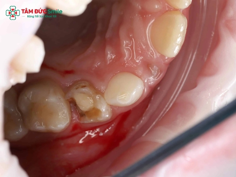 Răng bé bị sún cụt viêm tủy: Dấu hiệu và cách điều trị an toàn