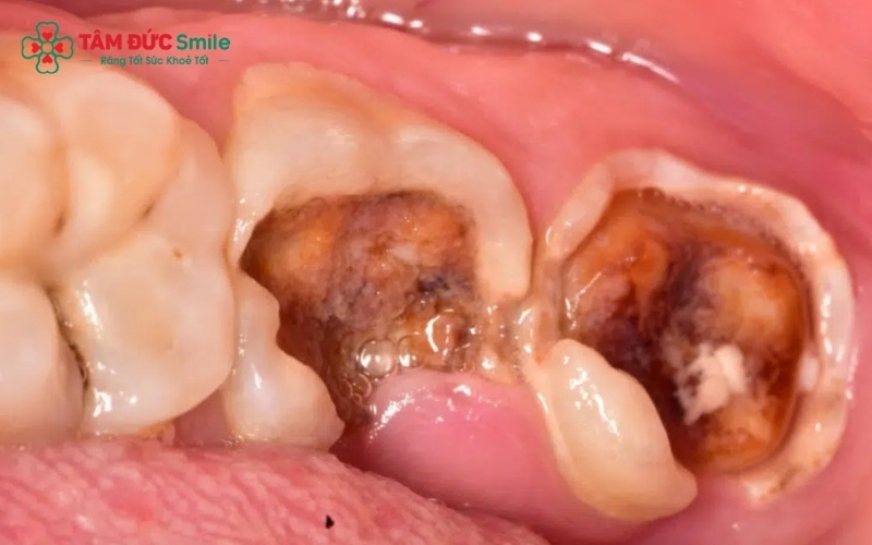 Cấu trúc răng bị phá hủy do vi khuẩn sâu răng khiến thân răng trở nên giòn, dễ vỡ vụn chỉ sau một tác động lực nhỏ