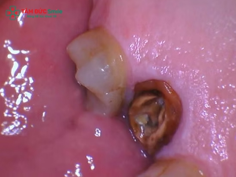 Răng hàm bị sâu chỉ còn chân răng: Cách xử lý an toàn, phục hồi ăn nhai tốt