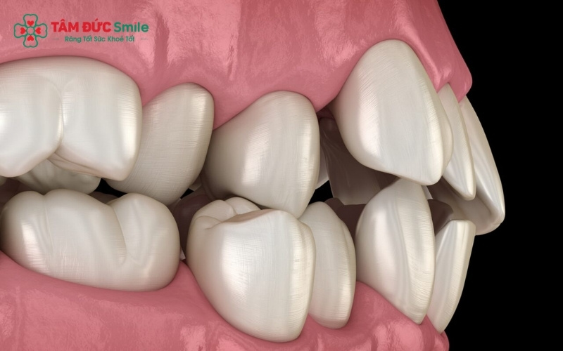 Nếu mọc ở mức độ vừa phải, răng khểnh 1 bên tạo nên nét duyên thầm cho nụ cười.