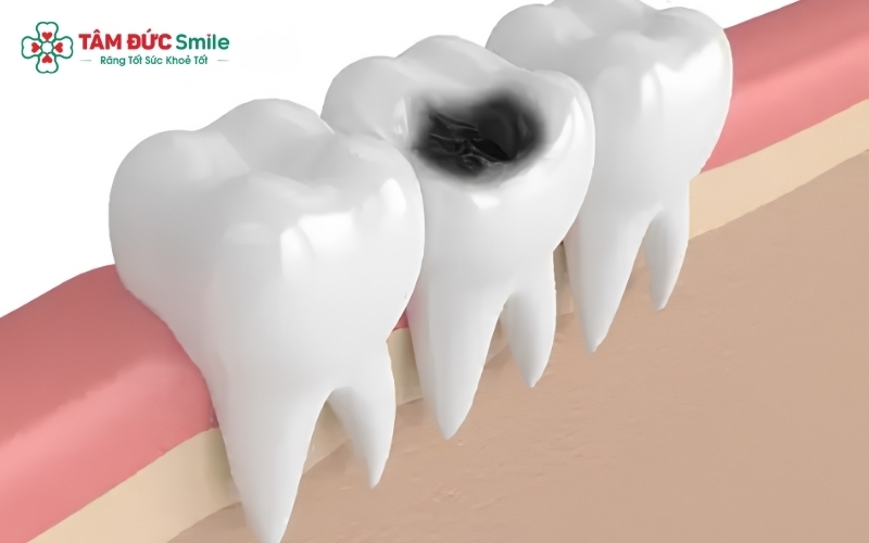 Cảm giác ê buốt nhói lên khi ăn đồ quá lạnh, nóng hoặc chua ngọt là dấu hiệu điển hình cho thấy răng sâu đang tiến triển nặng