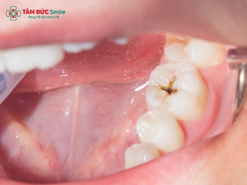 Răng sâu bị ê buốt: Nguyên nhân, dấu hiệu và cách điều trị