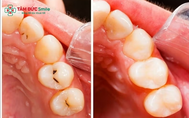 Tùy vào mức độ tổn thương, bác sĩ sẽ chỉ định trám răng, chữa tủy hoặc bọc răng sứ để loại bỏ ê buốt và bảo tồn răng thật.