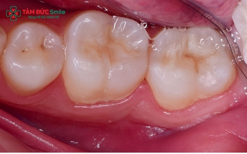 Ở giai đoạn chớm sâu (xuất hiện đốm trắng), việc tăng cường Fluoride và vệ sinh đúng cách có thể giúp tái khoáng hóa, ngăn chặn sâu răng tiến triển.