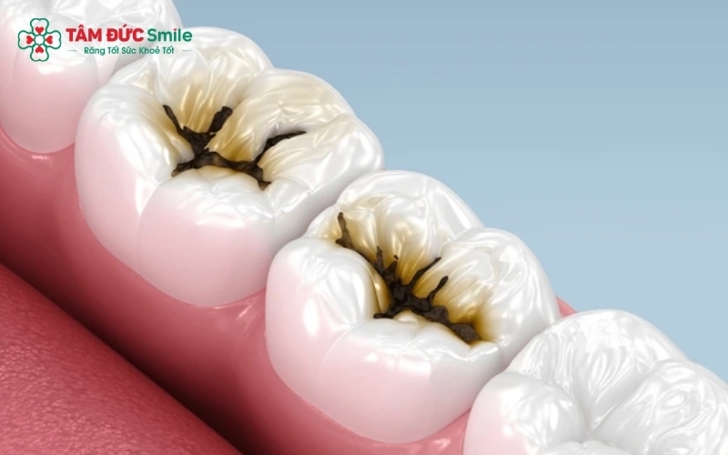 Răng sâu nếu không điều trị kịp thời sẽ dẫn đến viêm tủy, áp xe chân răng, thậm chí gây mất răng vĩnh viễn và ảnh hưởng đến các răng lân cận