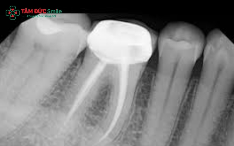 Số lượng ống tủy răng số 7 rất đa dạng (thường từ 3-4 ống), vì vậy việc chụp phim X-quang là bước bắt buộc để bác sĩ không bỏ sót bất kỳ ống tủy nào trong quá trình điều trị.