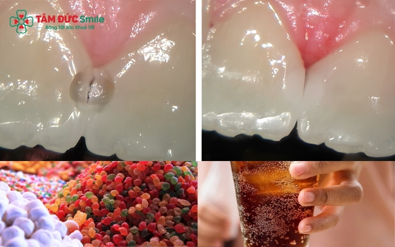 Thói quen ăn kẹo và nước ngọt, tạo môi trường lý tưởng cho vi khuẩn gây sâu răng phát triển.