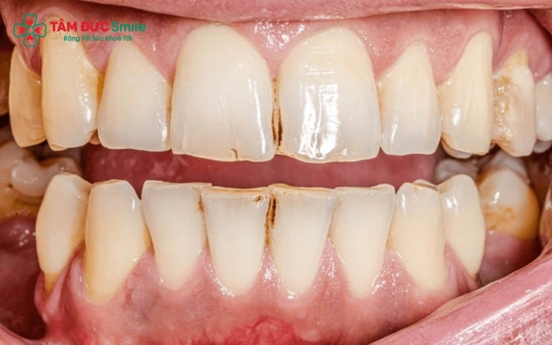 Sâu kẽ răng cửa nếu không điều trị kịp thời sẽ làm yếu cấu trúc răng, dẫn đến vỡ mẻ hoặc viêm tủy, gây mất thẩm mỹ nghiêm trọng.