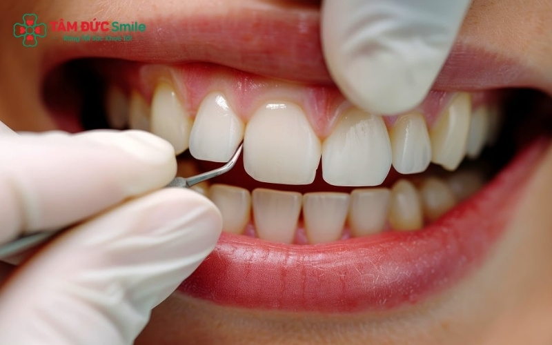 Trám răng thẩm mỹ hoặc bọc răng sứ tại Nha khoa Tâm Đức Smile giúp loại bỏ triệt để vết sâu và khôi phục nụ cười rạng rỡ cho khách hàng.
