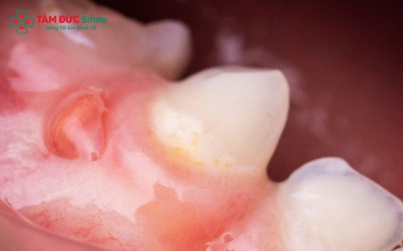 Dấu hiệu điển hình khi sưng chân răng cấm: Nướu đỏ mọng, sưng to và gây đau nhức khó chịu khi há miệng hoặc ăn uống