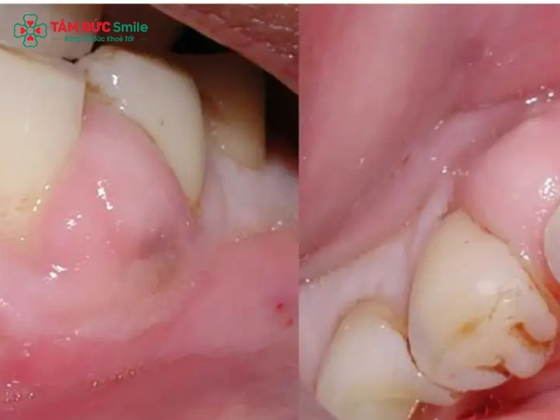 Sưng chân răng cấm: Nguyên nhân, dấu hiệu và cách điều trị