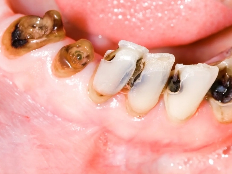 Trẻ 3 tuổi bị sâu răng hàm phải làm sao? Cách xử lý an toàn