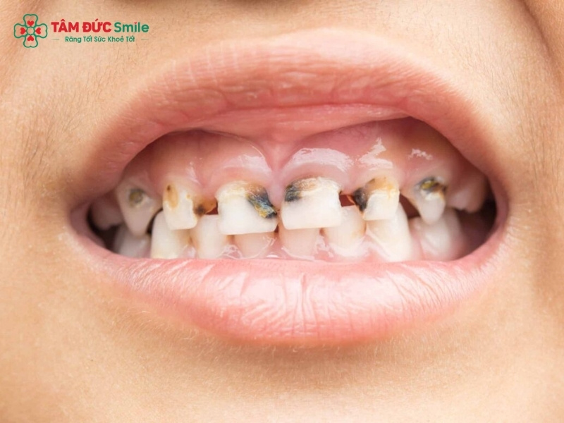 Trẻ bị sâu răng ăn vào tủy: Dấu hiệu nhận biết và cách điều trị hiệu quả