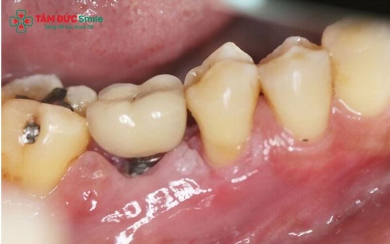 Tình trạng còn chân răng thường xảy ra do răng bị vỡ lớn, sâu nặng hoặc chấn thương; tùy vào sức khỏe của chân răng mà bác sĩ sẽ có phương án điều trị phù hợp
