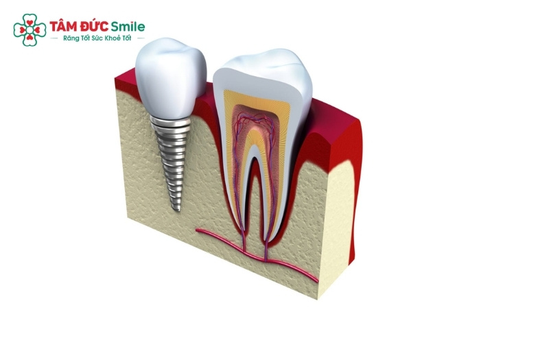  Nếu chân răng còn chắc khỏe, bác sĩ sẽ ưu tiên giữ lại để chữa tủy và bọc sứ; ngược lại, nếu chân răng đã hư hỏng nặng thì nhổ bỏ để cấy Implant