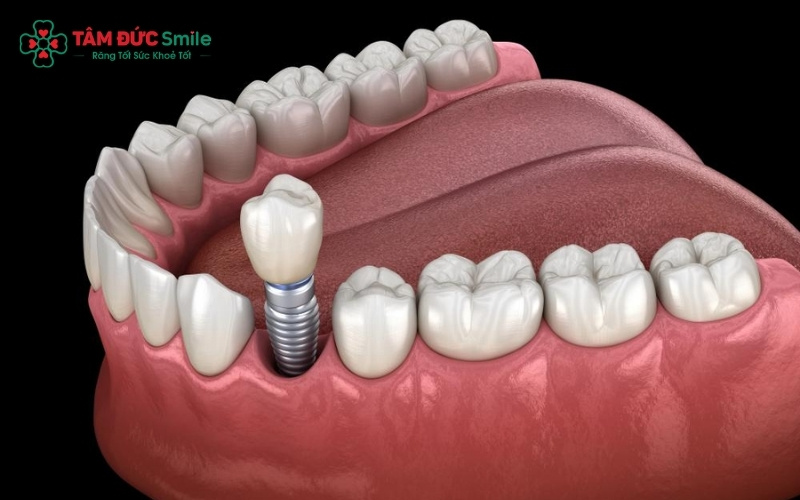Cấy ghép Implant là lựa chọn phổ biến nhất hiện nay để phục hình khi không còn chân răng thật