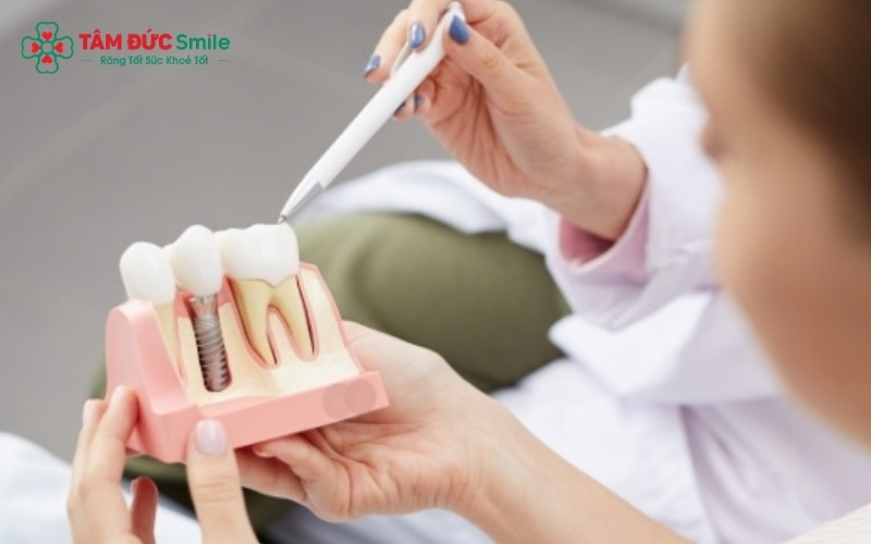 Mất chân răng lâu ngày dẫn đến tình trạng tiêu xương hàm nghiêm trọng, khiến nướu bị tụt và làm xô lệch toàn bộ hệ thống khớp cắn.