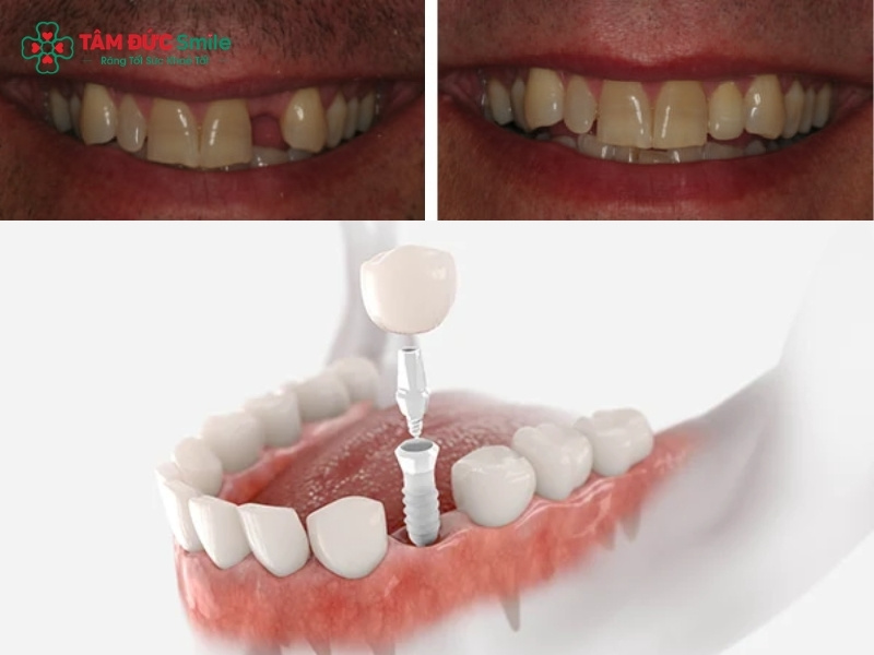 Trồng răng không có chân răng: phục hồi ăn nhai chắc chắn