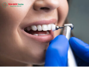 Vệ sinh răng sứ đúng cách, tránh hôi miệng và hở viền