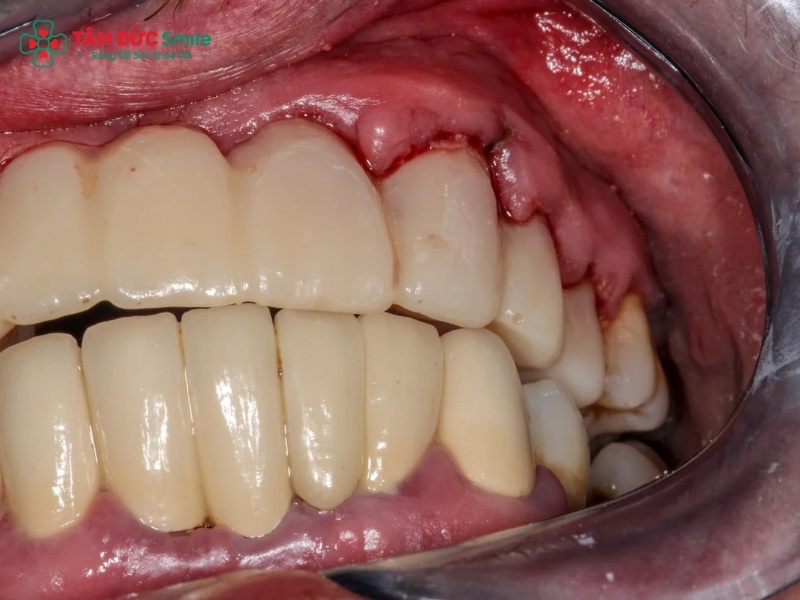 Viêm chân răng hàm dưới: dấu hiệu, nguyên nhân và cách điều trị hiệu quả