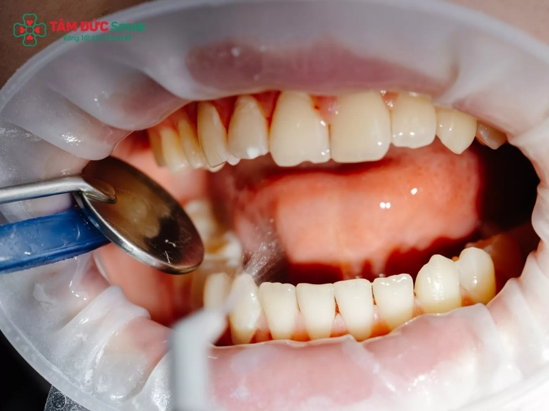 Viêm chân răng kiêng ăn gì? Cách giảm sưng nướu, đau nhức