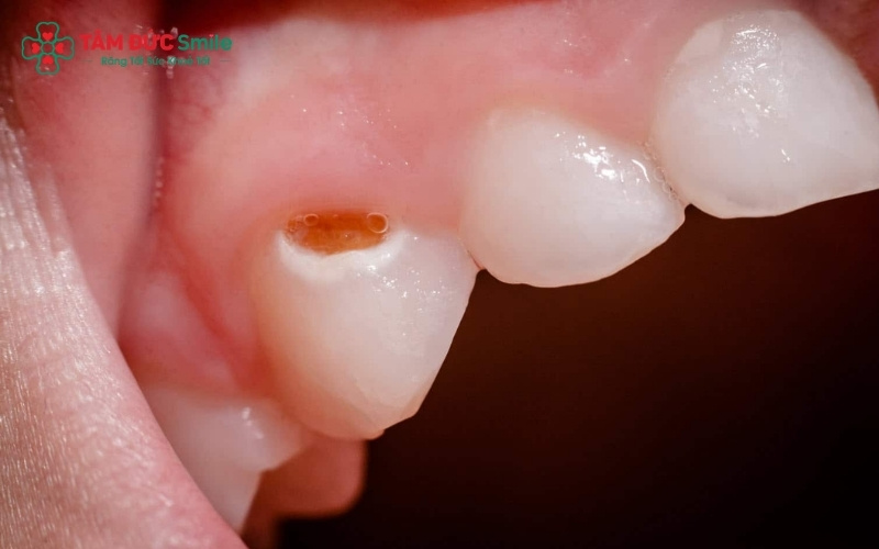 Khi thấy nướu của bé bị sưng hoặc xuất hiện mụn mủ ngay chân răng, đây là dấu hiệu nhiễm trùng tủy đã lan rộng ra vùng chóp răng.