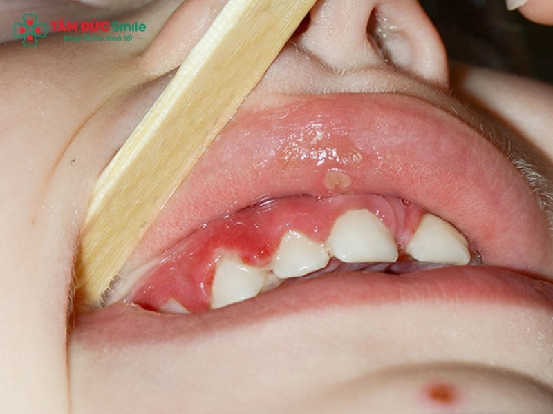 Viêm tủy răng ở trẻ em: Dấu hiệu, điều trị tủy răng sữa