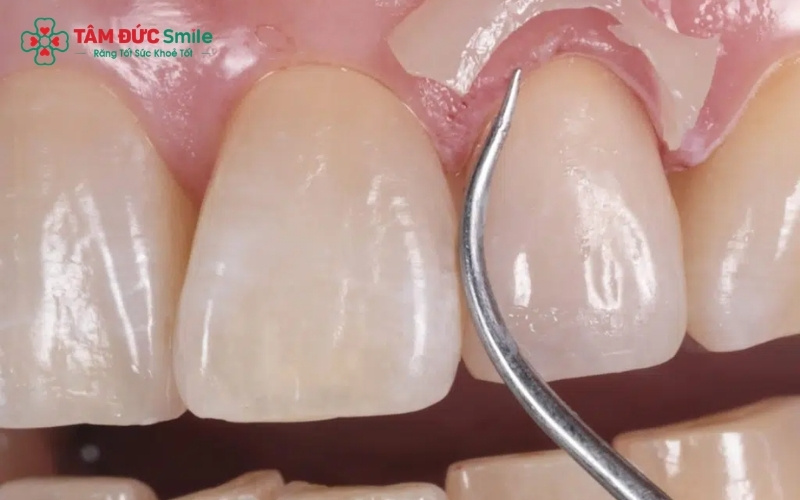  Bọc răng sứ dính liền thường được chỉ định cho trường hợp mất răng, sử dụng hai răng thật bên cạnh làm trụ đỡ cho nhịp cầu