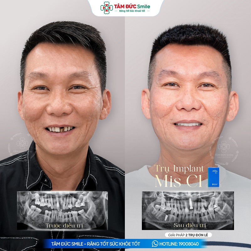 Khách hàng Đức Trần cấy ghép 2 trụ Implant MIS C1, kết hợp phục hình 18 răng sứ.