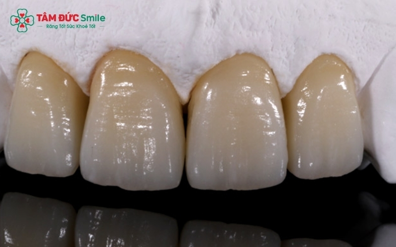 Dòng sứ HT đòi hỏi quy trình chế tác tinh xảo và sự chỉ định chính xác từ bác sĩ để đảm bảo độ bền cũng như hiệu quả thẩm mỹ cao nhất.